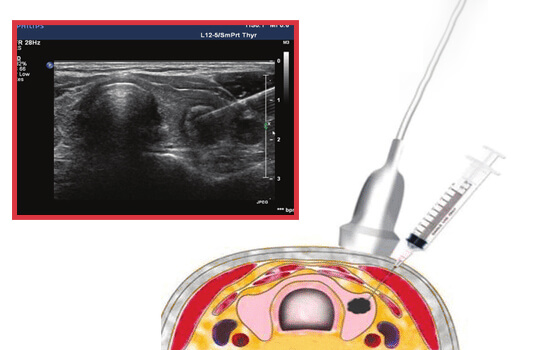 Biopsy Of Solid Organs