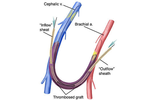 Dialysis access maintenance