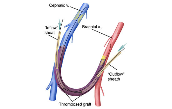 Dialysis Access & Venous Access