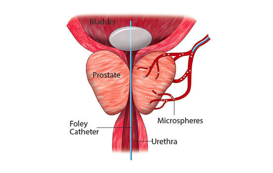 Enlarged Prostate Embolization