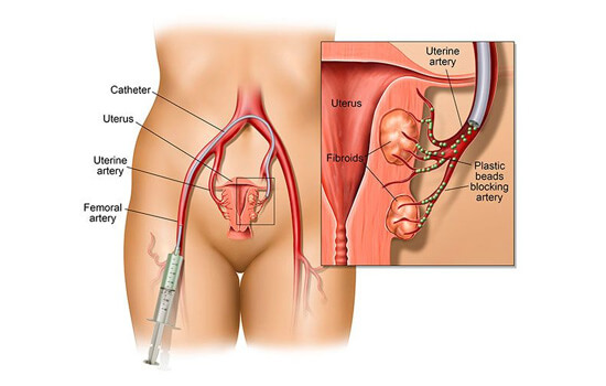 Uterine Fibroid Embolization