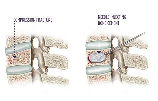 Kyphoplasty for vertebral fracture