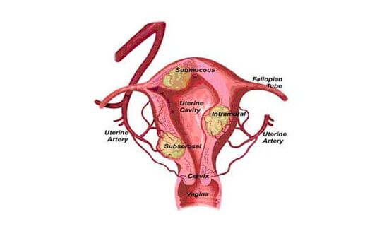 Uterine Fibroid embolization