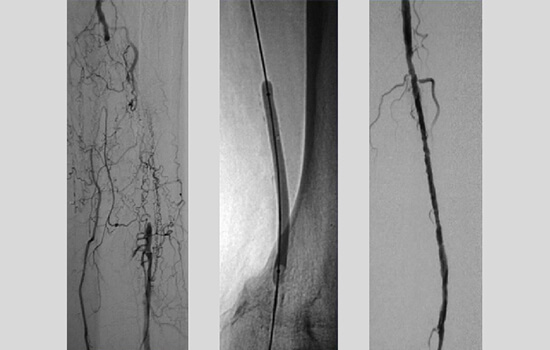 Vascular Intervention - Lower extremity