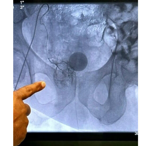 Prostate Artery Embolization For BPH