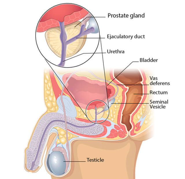 Prostate Artery Embolization For BPH