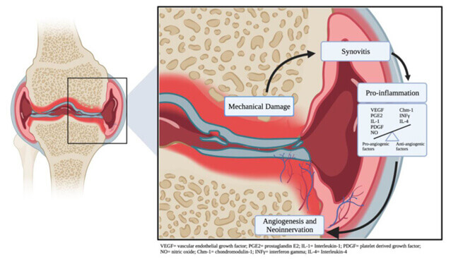 What is Knee Osteoarthritis(OA)?
