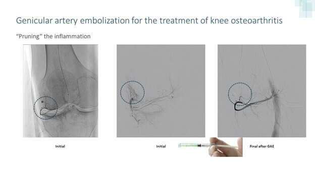 knee-pain-1