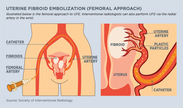 Prostate Artery Embolization For BPH