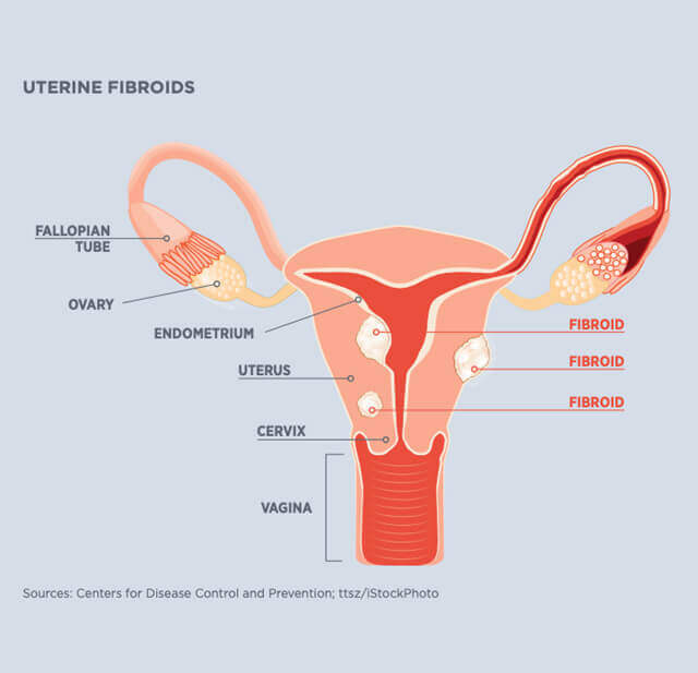 Myths & Mysteries about Uterine fibroid embolization(UFE)!