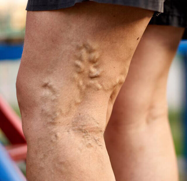 Varicose veins/ chronic venous insufficiency